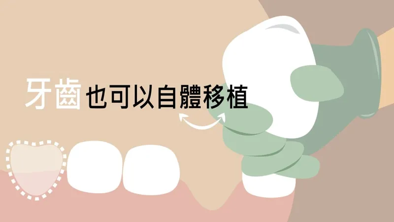 Teeth Can Be Autotransplanted Too