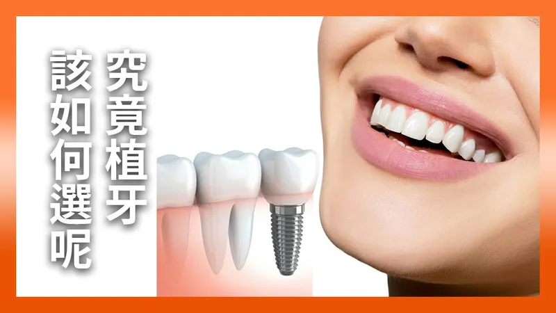 How Should You Choose Dental Implants?