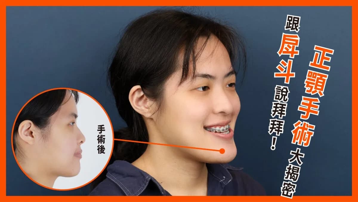 正顎手術大揭密,與戽斗說掰掰!