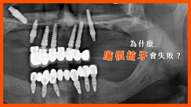 What Cheap Dental Implants Really Lead To