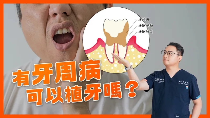 Can You Get Dental Implants with Periodontal Disease?