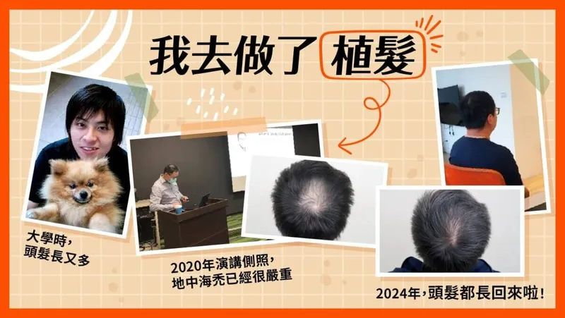 我去做了植髮!挑選醫師的技巧!