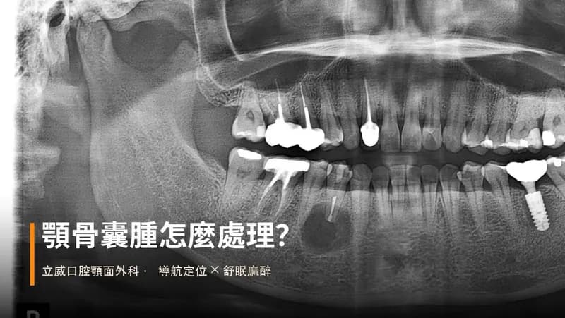 顎骨囊腫怎麼處理?導航手術一次解析