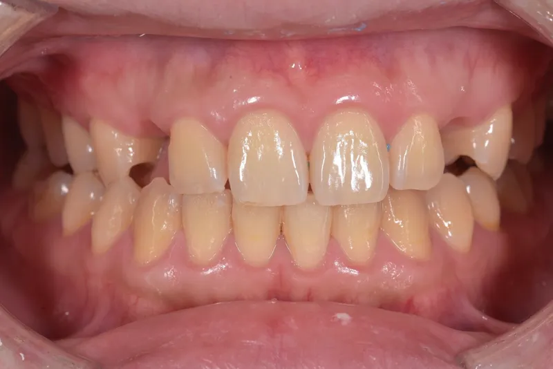 Do Crooked Teeth Affect a Child's Health?