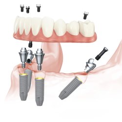 All-on-4 Mandible NobelParallel